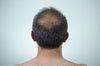 What is DHT & Why Does It Cause Hair Loss?