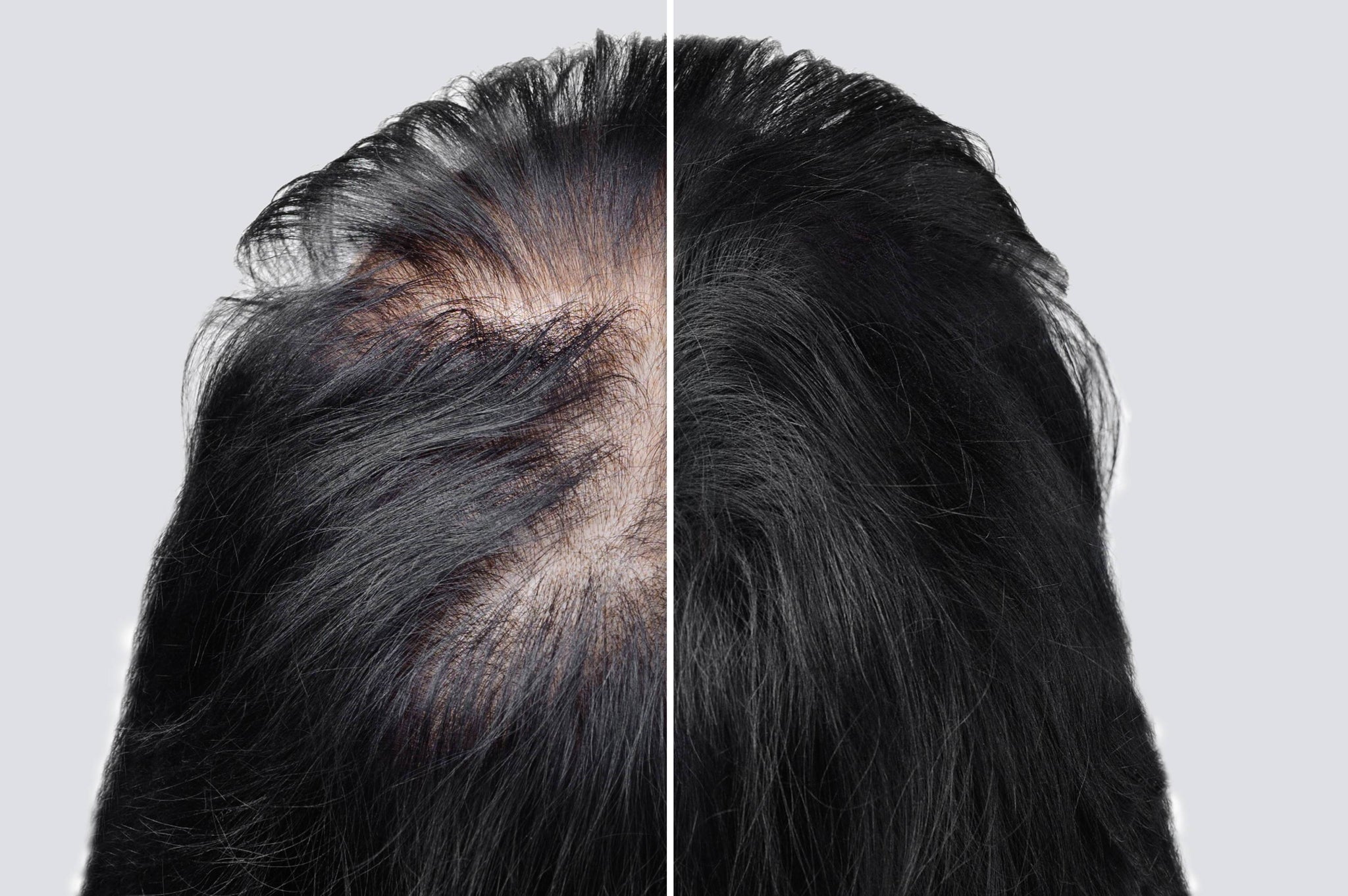 Understanding the Different Types of Hair Loss